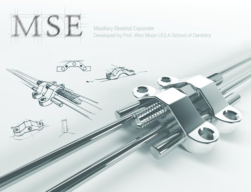 Digital MSE Refill Kit Moon-Mompell (reposición): Disyuntor + 4 Minitornillos + llaves de activación larga + corta (No incluye Montaje de laboratorio)