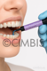 Adhesivo fotopolimerizable para ataches de Aligners y retenedores linguales.(Kit: 2 jer.adhesivo+2 jer. ácido fosfórico)